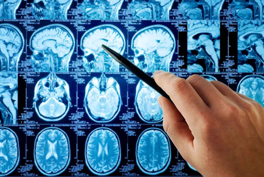 118491940 featured image Hand pointing at brain scan images on screen.